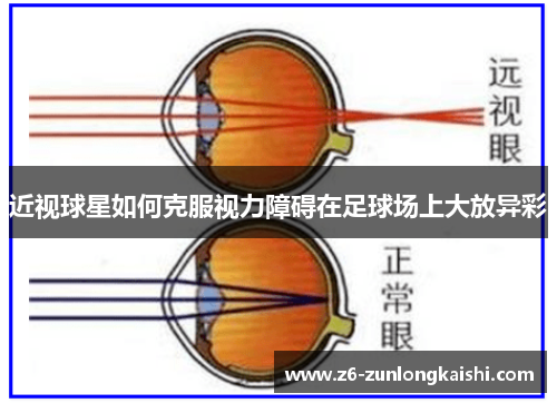近视球星如何克服视力障碍在足球场上大放异彩